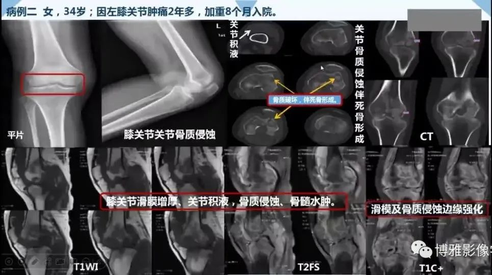 影像PPT - 【PPT】论T2低信号几种腱鞘滑膜疾病-26