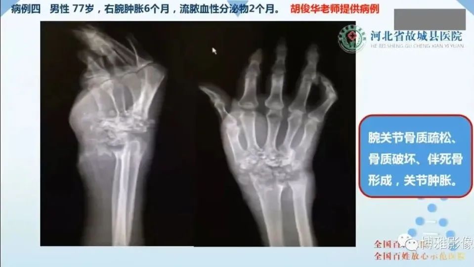 影像PPT - 【PPT】论T2低信号几种腱鞘滑膜疾病-29