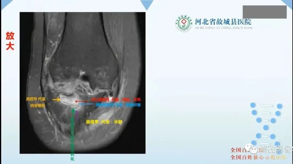 影像PPT - 【PPT】论T2低信号几种腱鞘滑膜疾病-28