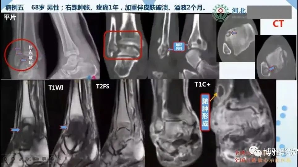 影像PPT - 【PPT】论T2低信号几种腱鞘滑膜疾病-30