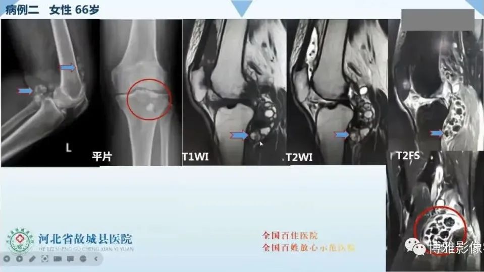 影像PPT - 【PPT】论T2低信号几种腱鞘滑膜疾病-34