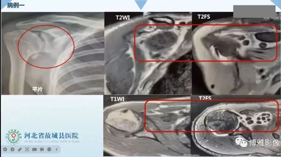 影像PPT - 【PPT】论T2低信号几种腱鞘滑膜疾病-33
