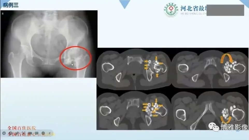 影像PPT - 【PPT】论T2低信号几种腱鞘滑膜疾病-35