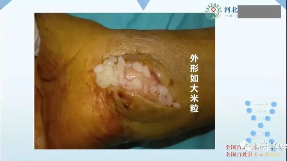 影像PPT - 【PPT】论T2低信号几种腱鞘滑膜疾病-37