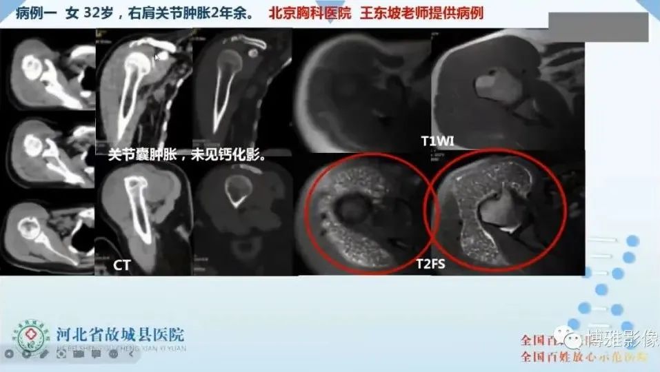 影像PPT - 【PPT】论T2低信号几种腱鞘滑膜疾病-38