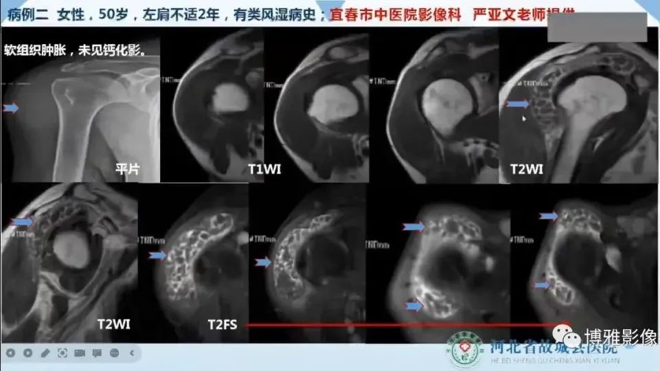 影像PPT - 【PPT】论T2低信号几种腱鞘滑膜疾病-39