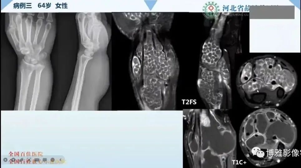 影像PPT - 【PPT】论T2低信号几种腱鞘滑膜疾病-40