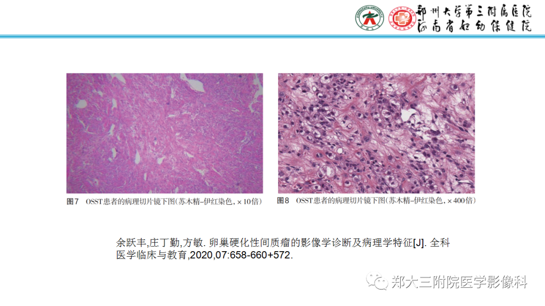 影像PPT - 【PPT】呈“湖岛征”影像表现的卵巢硬化性间质瘤-5
