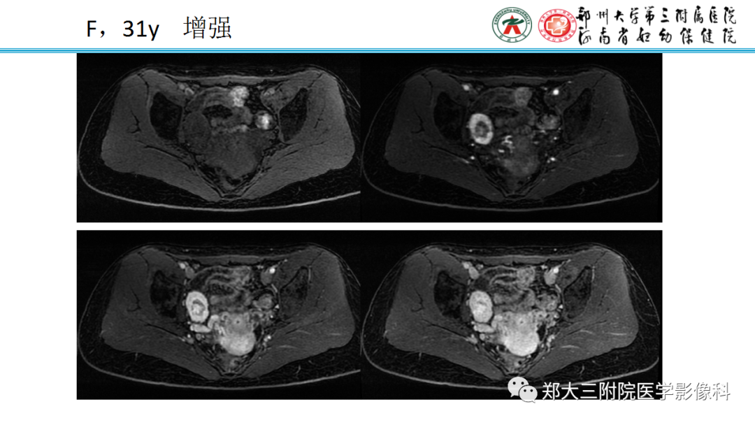 影像PPT - 【PPT】呈“湖岛征”影像表现的卵巢硬化性间质瘤-15