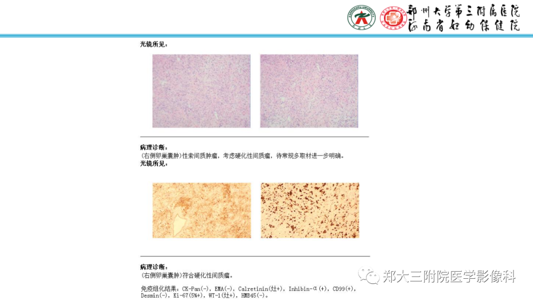 影像PPT - 【PPT】呈“湖岛征”影像表现的卵巢硬化性间质瘤-17