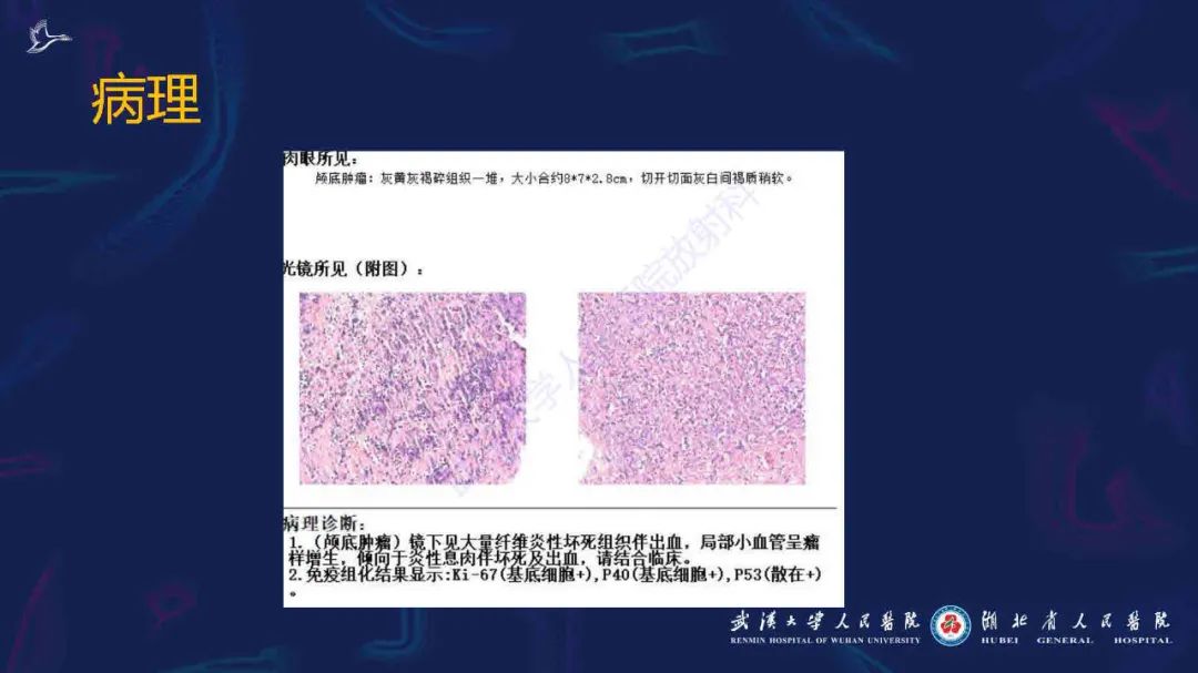 影像PPT - 【PPT】出血坏死性鼻息肉影像诊断-5