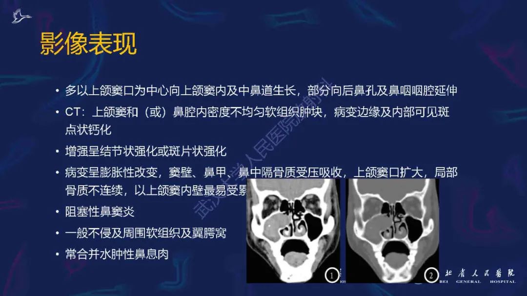 影像PPT - 【PPT】出血坏死性鼻息肉影像诊断-10