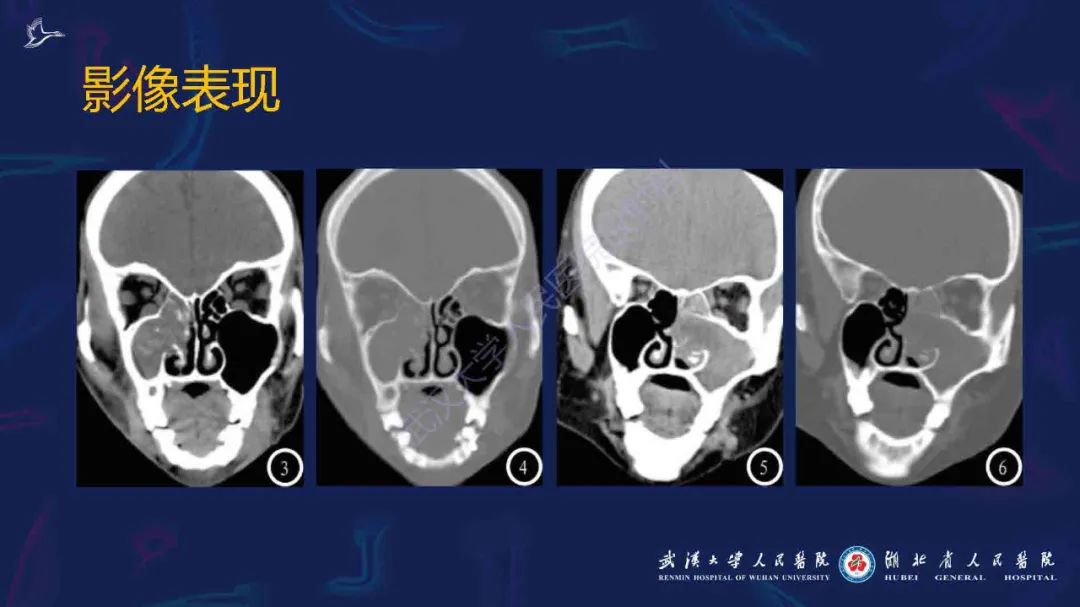 影像PPT - 【PPT】出血坏死性鼻息肉影像诊断-11