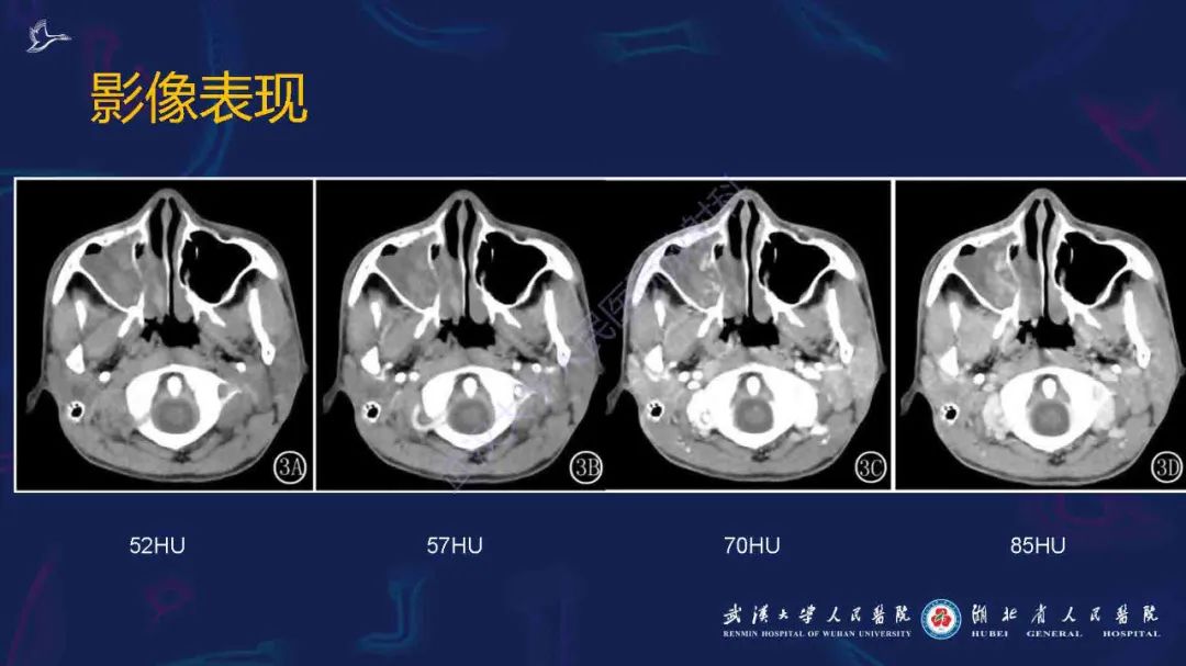影像PPT - 【PPT】出血坏死性鼻息肉影像诊断-12