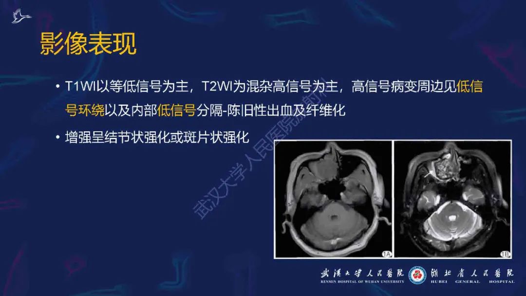 影像PPT - 【PPT】出血坏死性鼻息肉影像诊断-13