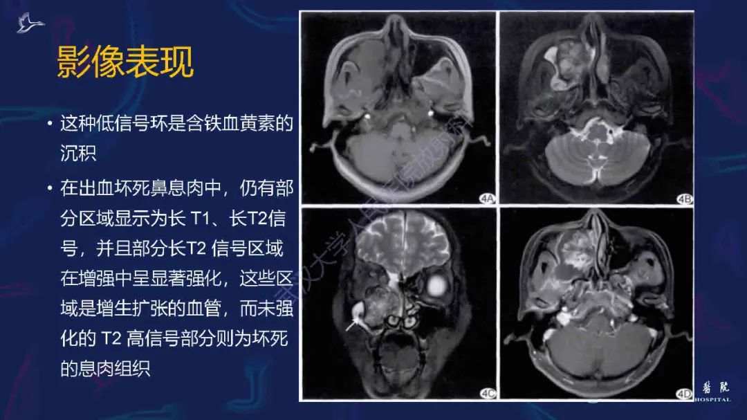 影像PPT - 【PPT】出血坏死性鼻息肉影像诊断-14