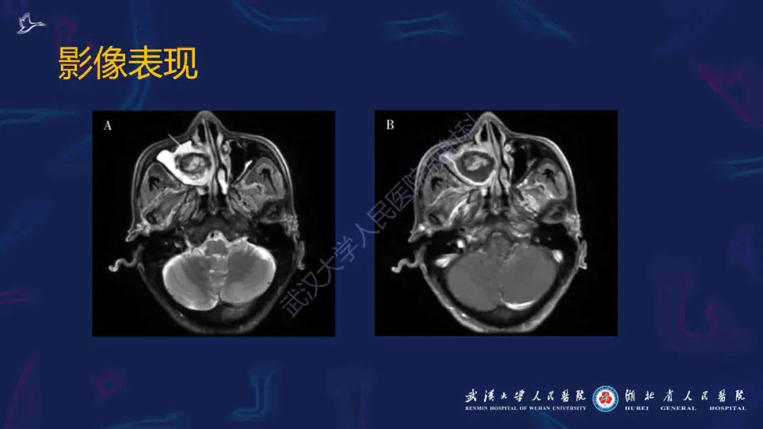 影像PPT - 【PPT】出血坏死性鼻息肉影像诊断-15