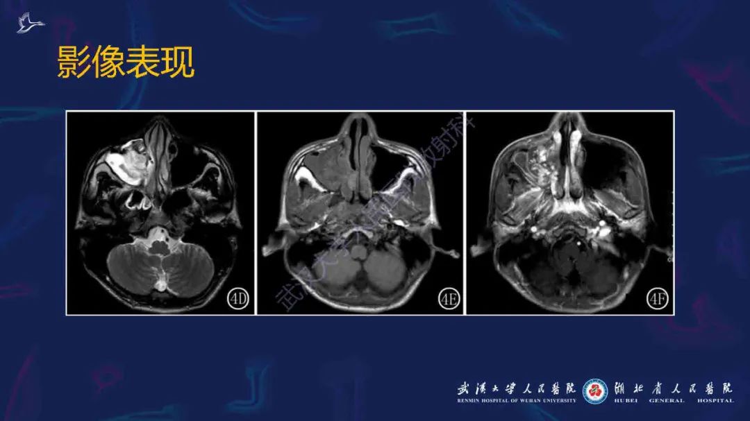 影像PPT - 【PPT】出血坏死性鼻息肉影像诊断-16