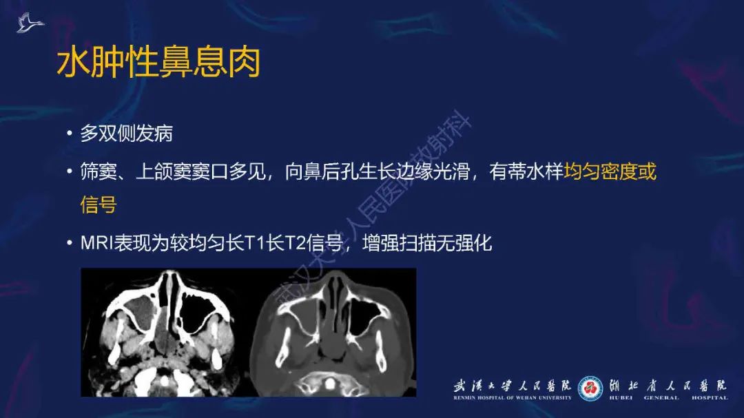 影像PPT - 【PPT】出血坏死性鼻息肉影像诊断-18