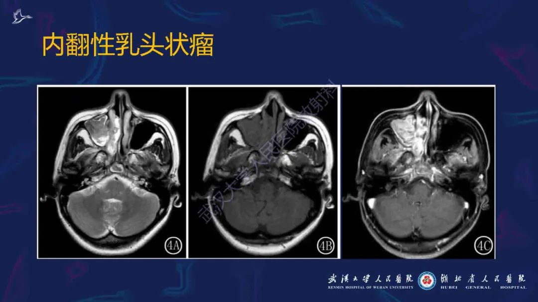 影像PPT - 【PPT】出血坏死性鼻息肉影像诊断-20