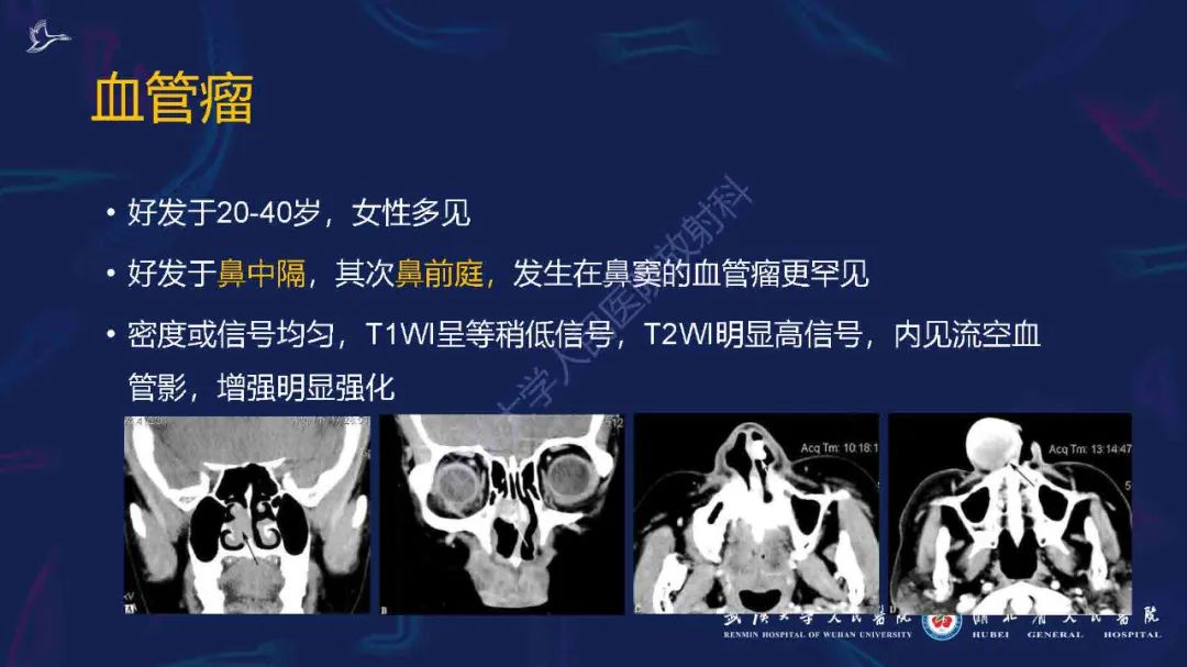 影像PPT - 【PPT】出血坏死性鼻息肉影像诊断-21