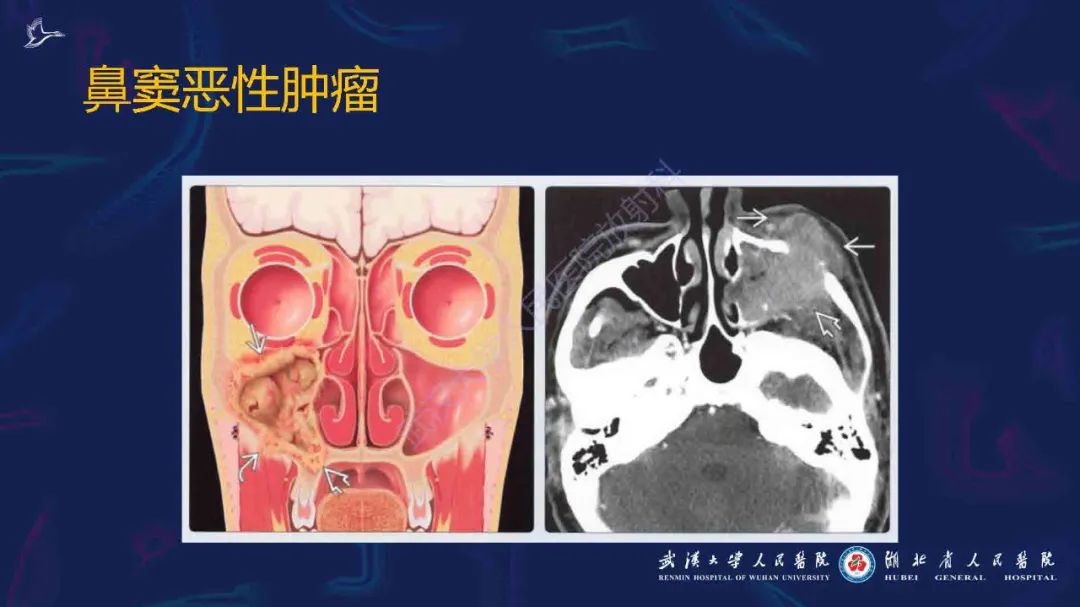 影像PPT - 【PPT】出血坏死性鼻息肉影像诊断-23