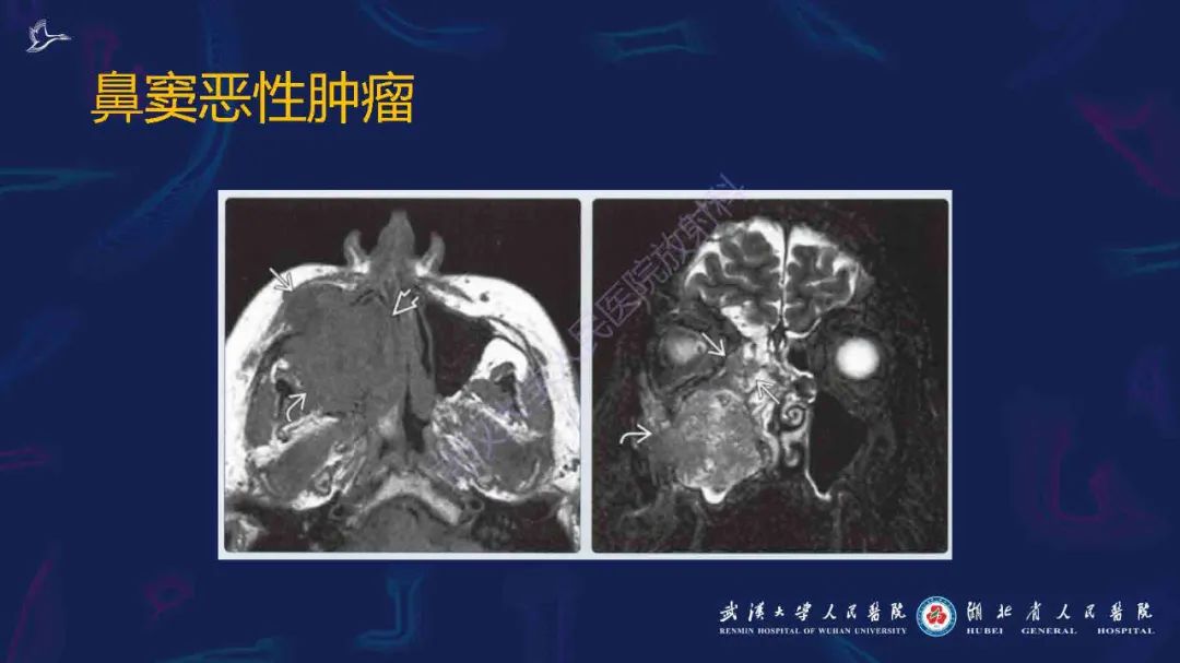 影像PPT - 【PPT】出血坏死性鼻息肉影像诊断-24