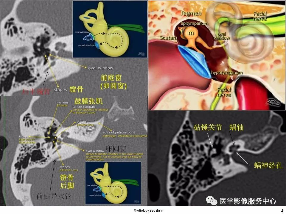 影像PPT - 耳硬化症中的“双环征”-2 影像PPT - 耳硬化症中的“双环征”-2