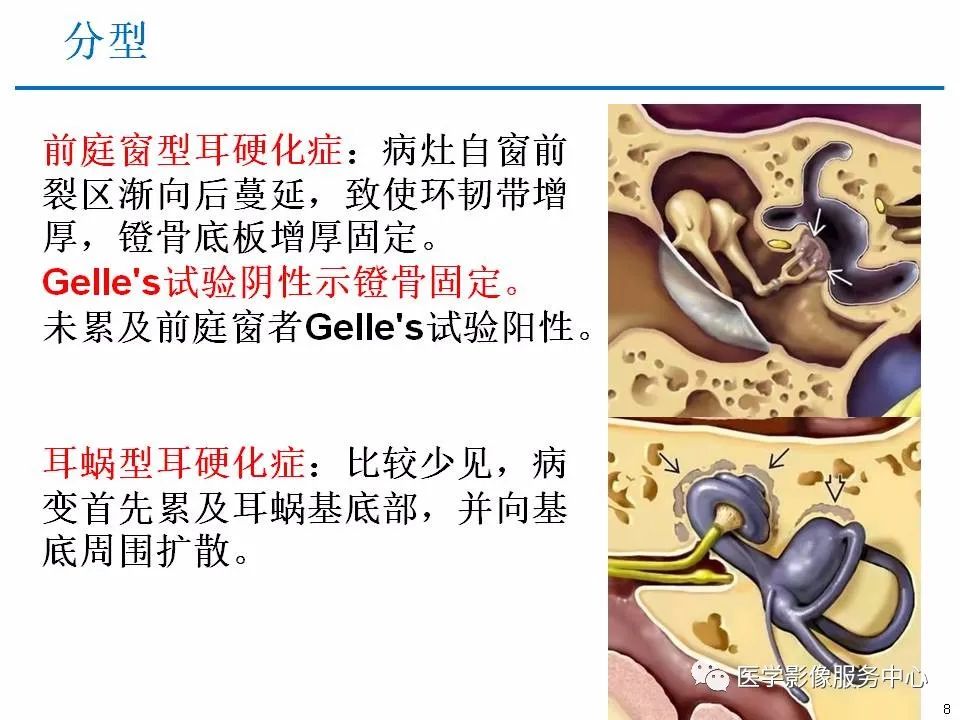 影像PPT - 耳硬化症中的“双环征”-6 影像PPT - 耳硬化症中的“双环征”-6