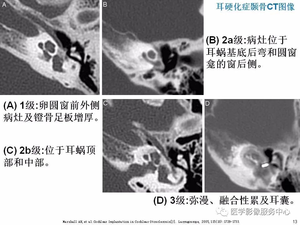 影像PPT - 耳硬化症中的“双环征”-11 影像PPT - 耳硬化症中的“双环征”-11