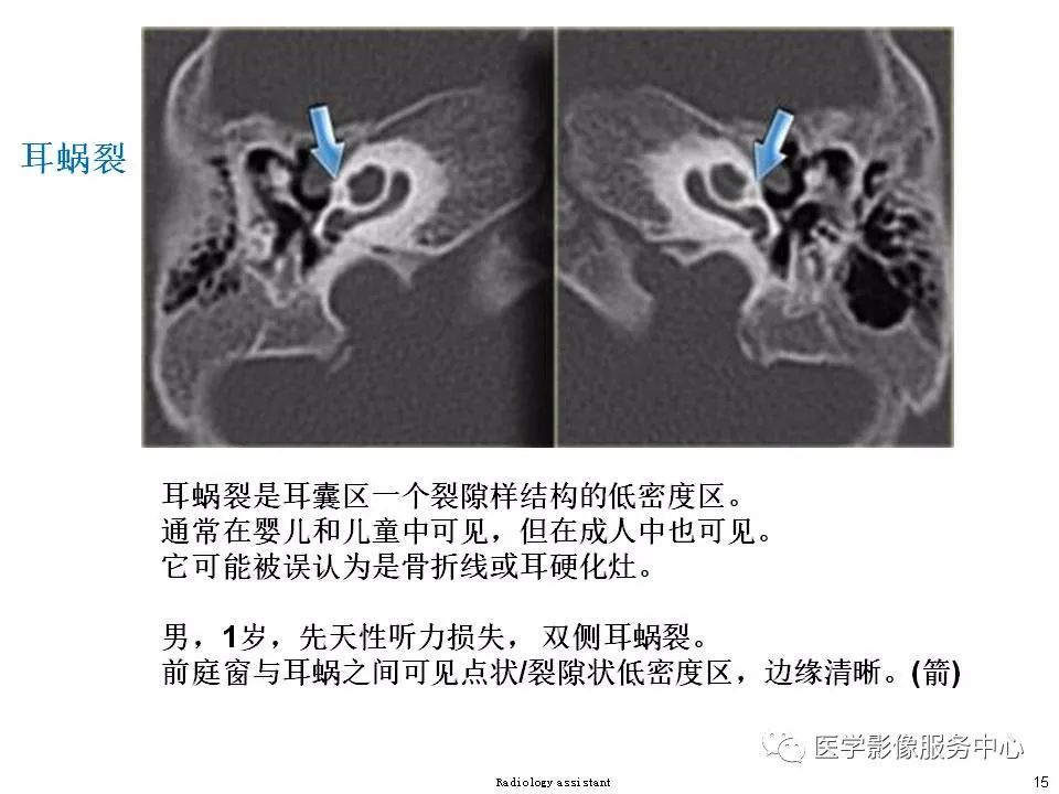 影像PPT - 耳硬化症中的“双环征”-13 影像PPT - 耳硬化症中的“双环征”-13