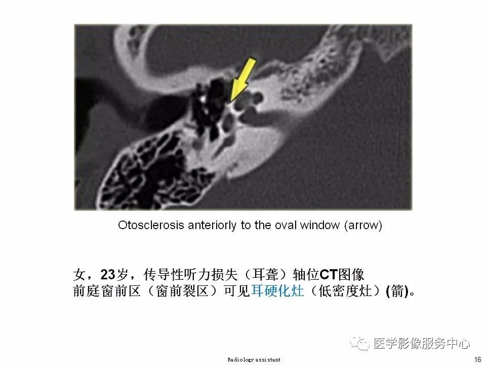 影像PPT - 耳硬化症中的“双环征”-14 影像PPT - 耳硬化症中的“双环征”-14