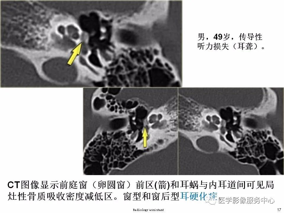 影像PPT - 耳硬化症中的“双环征”-15 影像PPT - 耳硬化症中的“双环征”-15