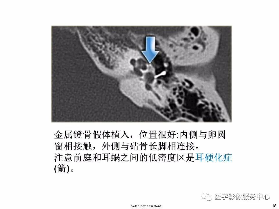 影像PPT - 耳硬化症中的“双环征”-16 影像PPT - 耳硬化症中的“双环征”-16