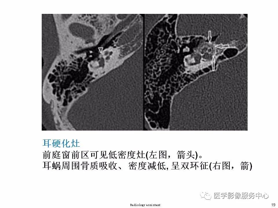 影像PPT - 耳硬化症中的“双环征”-17 影像PPT - 耳硬化症中的“双环征”-17