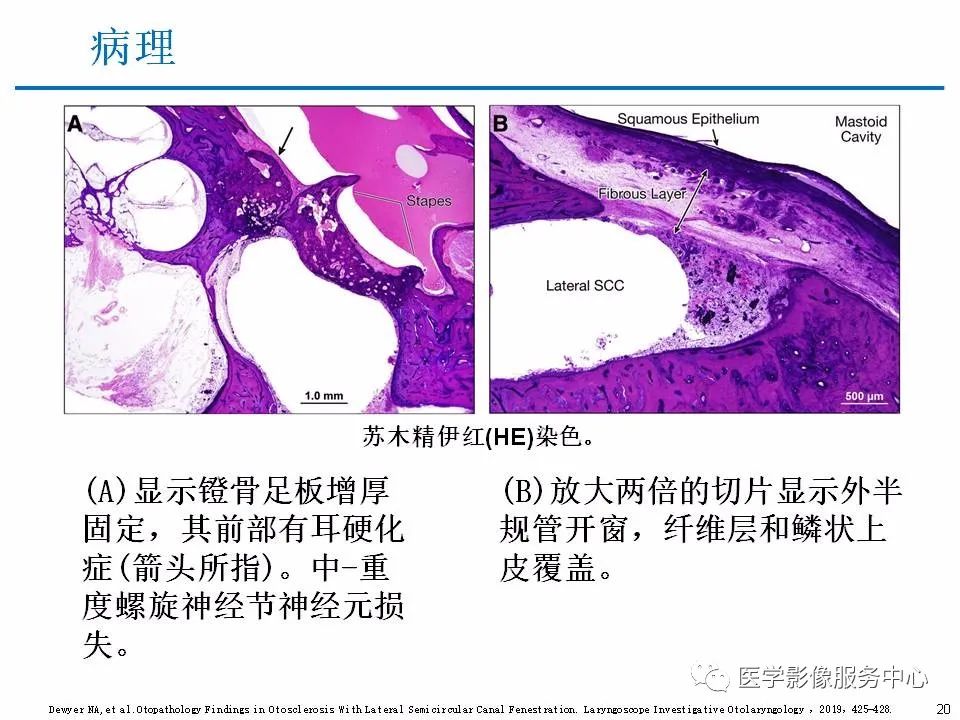 影像PPT - 耳硬化症中的“双环征”-18 影像PPT - 耳硬化症中的“双环征”-18