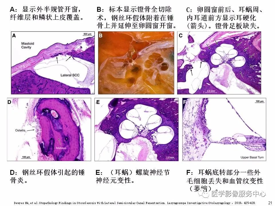 影像PPT - 耳硬化症中的“双环征”-19 影像PPT - 耳硬化症中的“双环征”-19