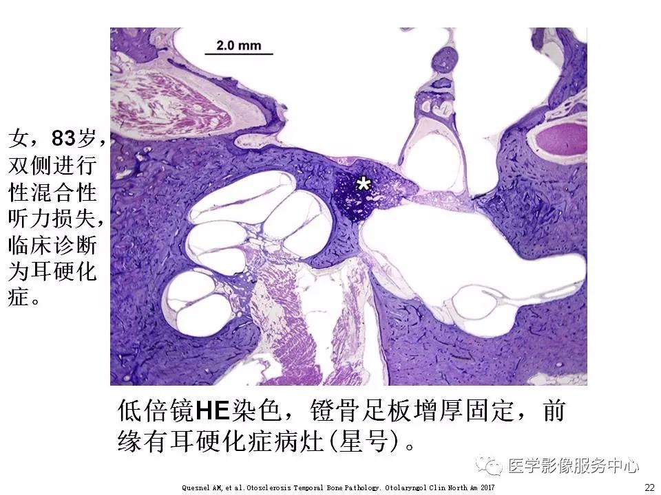 影像PPT - 耳硬化症中的“双环征”-20 影像PPT - 耳硬化症中的“双环征”-20