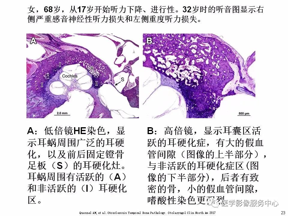 影像PPT - 耳硬化症中的“双环征”-21 影像PPT - 耳硬化症中的“双环征”-21