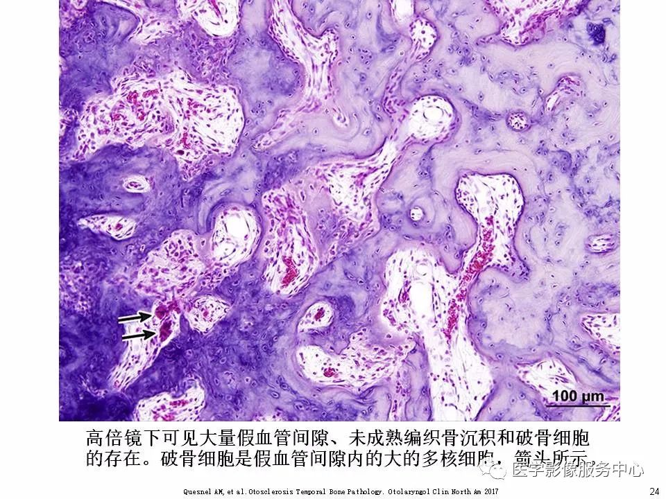 影像PPT - 耳硬化症中的“双环征”-22 影像PPT - 耳硬化症中的“双环征”-22
