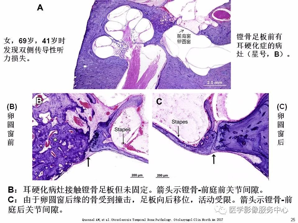 影像PPT - 耳硬化症中的“双环征”-23 影像PPT - 耳硬化症中的“双环征”-23
