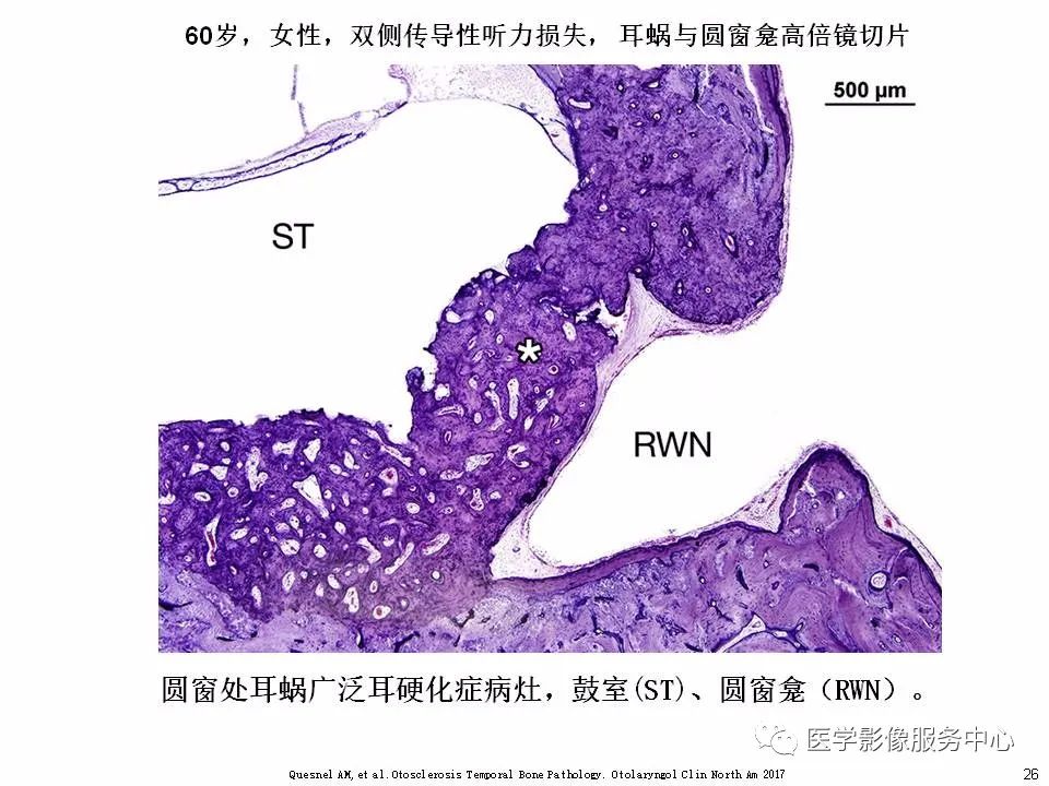 影像PPT - 耳硬化症中的“双环征”-24 影像PPT - 耳硬化症中的“双环征”-24