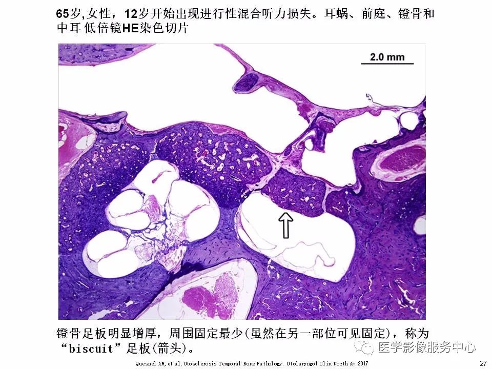影像PPT - 耳硬化症中的“双环征”-25 影像PPT - 耳硬化症中的“双环征”-25