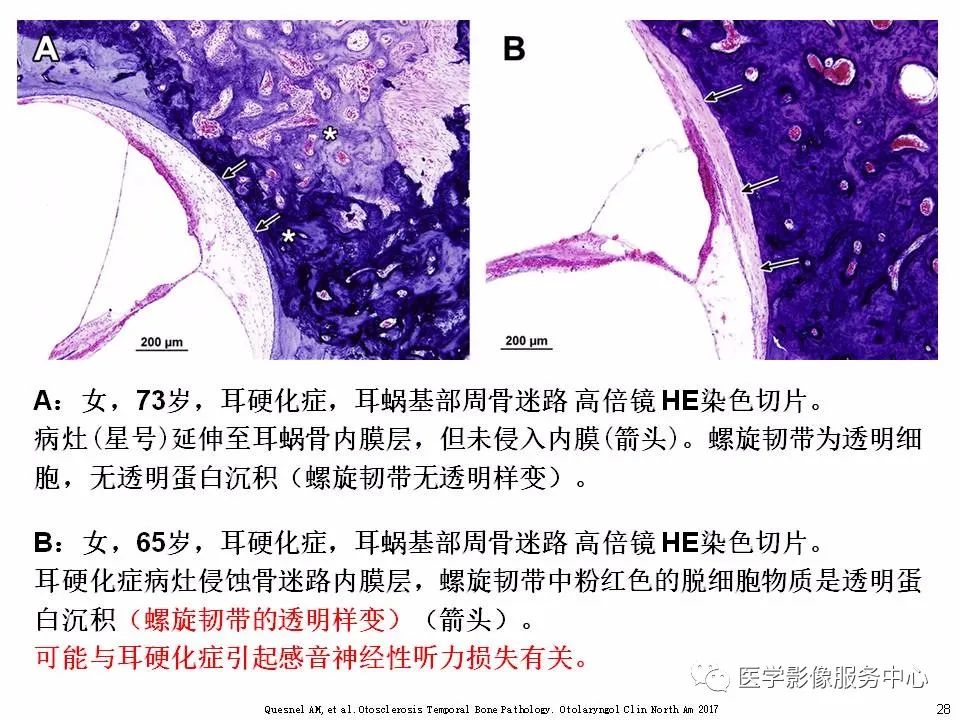 影像PPT - 耳硬化症中的“双环征”-26 影像PPT - 耳硬化症中的“双环征”-26