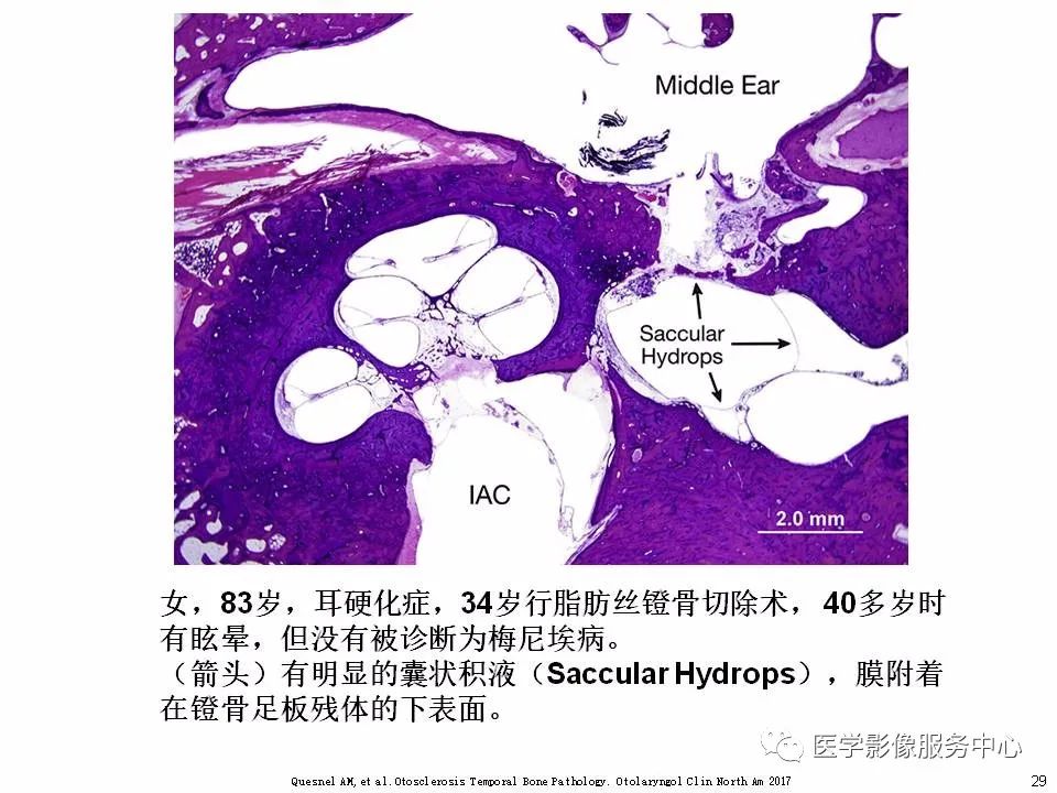 影像PPT - 耳硬化症中的“双环征”-27 影像PPT - 耳硬化症中的“双环征”-27