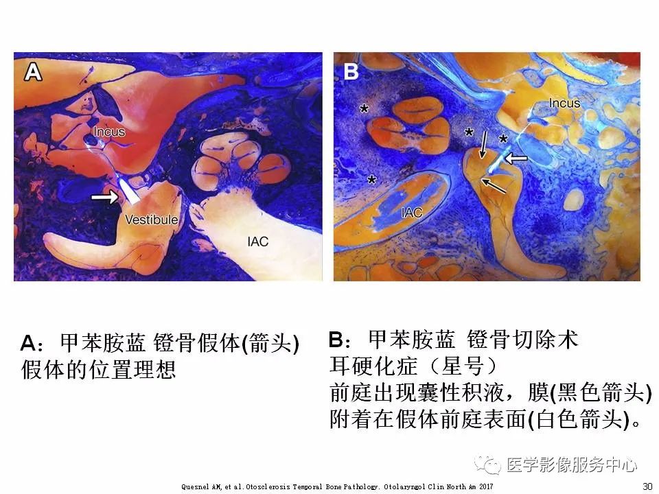 影像PPT - 耳硬化症中的“双环征”-28 影像PPT - 耳硬化症中的“双环征”-28