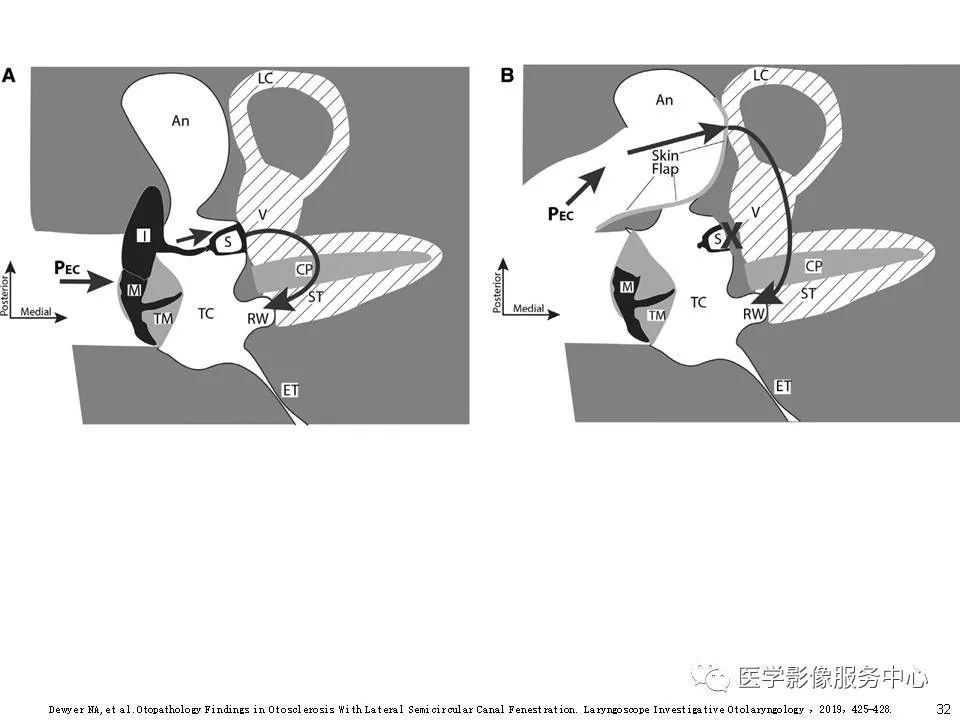 影像PPT - 耳硬化症中的“双环征”-30 影像PPT - 耳硬化症中的“双环征”-30