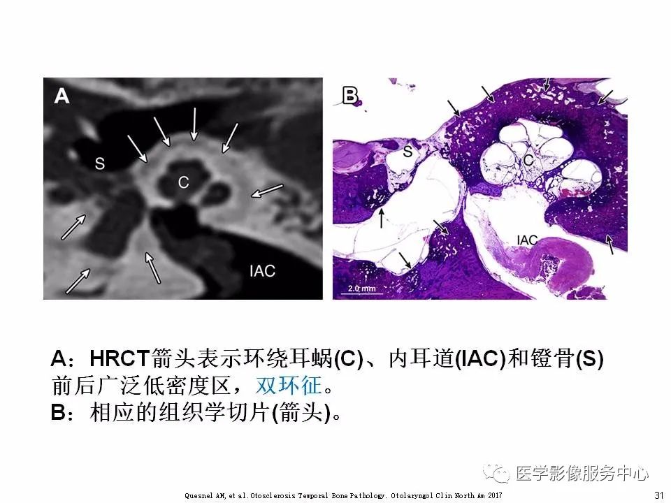 影像PPT - 耳硬化症中的“双环征”-29 影像PPT - 耳硬化症中的“双环征”-29