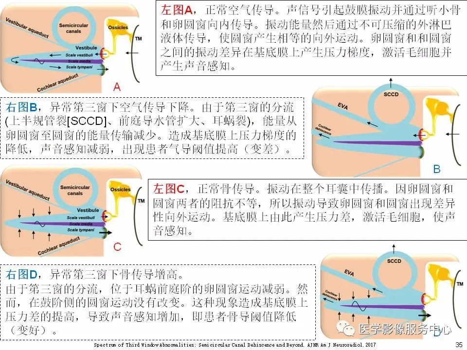 影像PPT - 耳硬化症中的“双环征”-33 影像PPT - 耳硬化症中的“双环征”-33