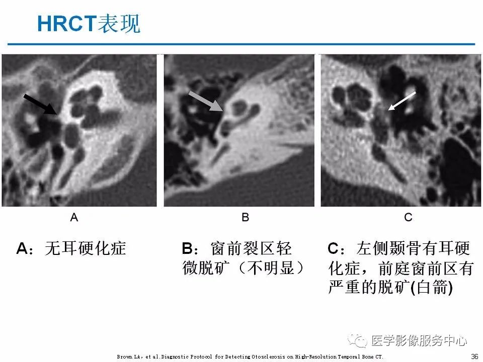 影像PPT - 耳硬化症中的“双环征”-34 影像PPT - 耳硬化症中的“双环征”-34